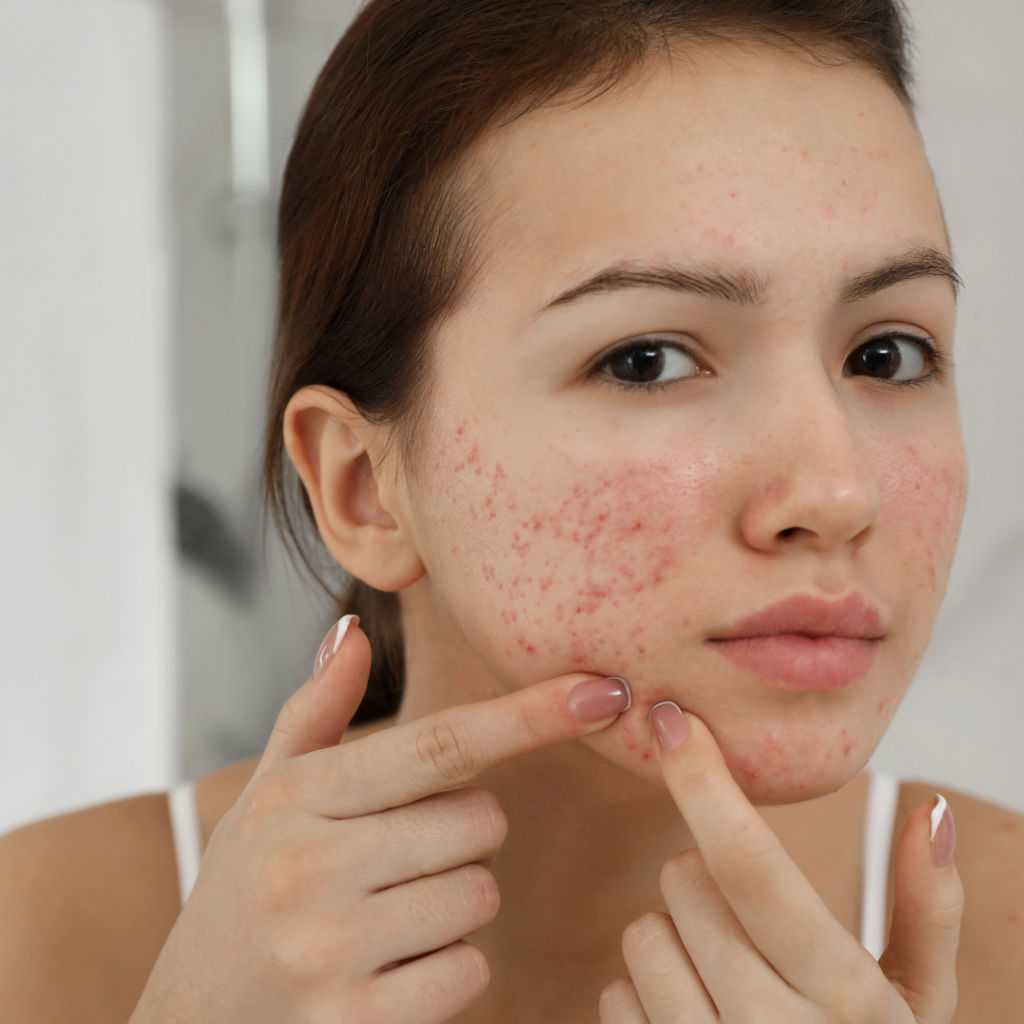 acne scar treatment in Gurugram