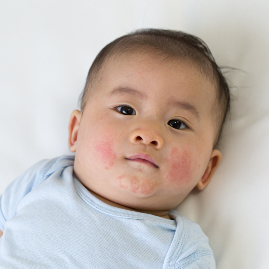 Pediatric Eczema treatment in gurugram