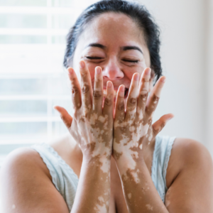 best skin clinic in gurugram vitiligo treatment in gurugram